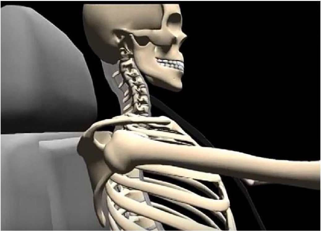 does whiplash affect your back