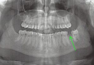 Xray showing dental malpractice for wrong tooth extraction