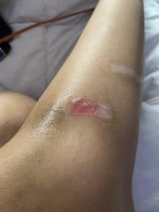Laser burn injuries caused by negligence at a med spa